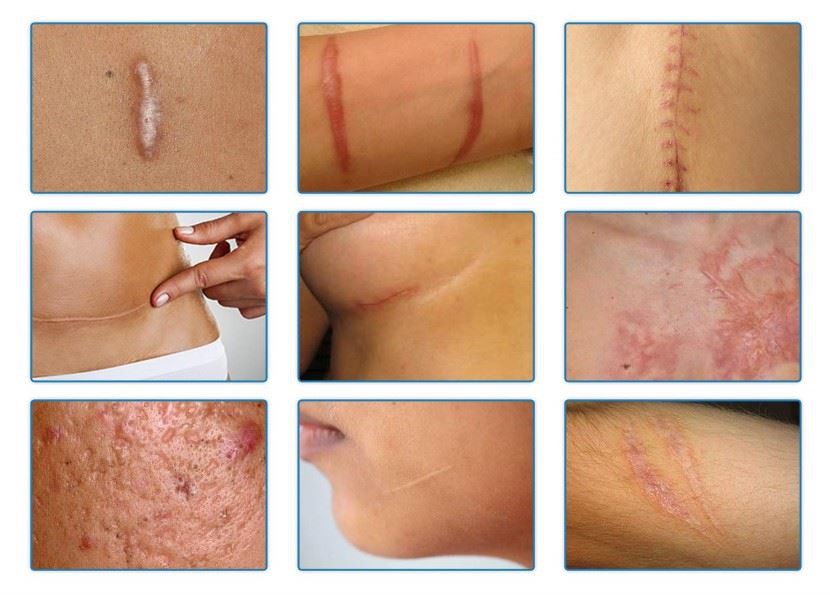 silicone gel sheet 11